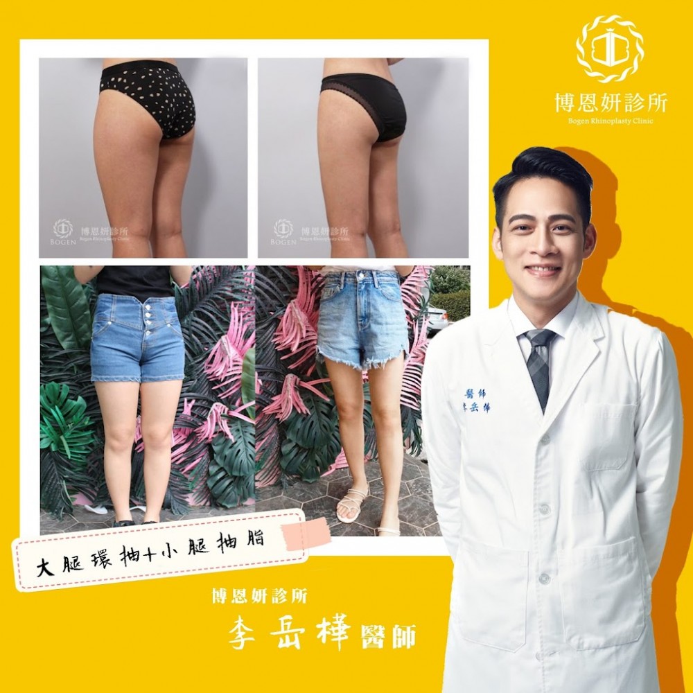 威塑抽脂改善大腿脂肪,威塑抽脂,威塑,李岳樺醫師,博恩妍
